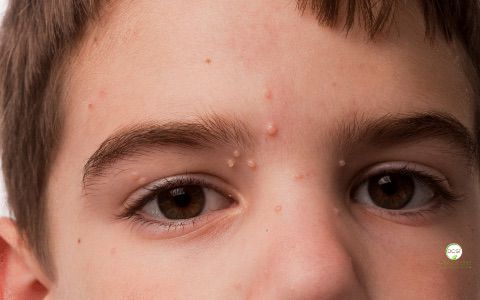 Molloscum Contagiosum